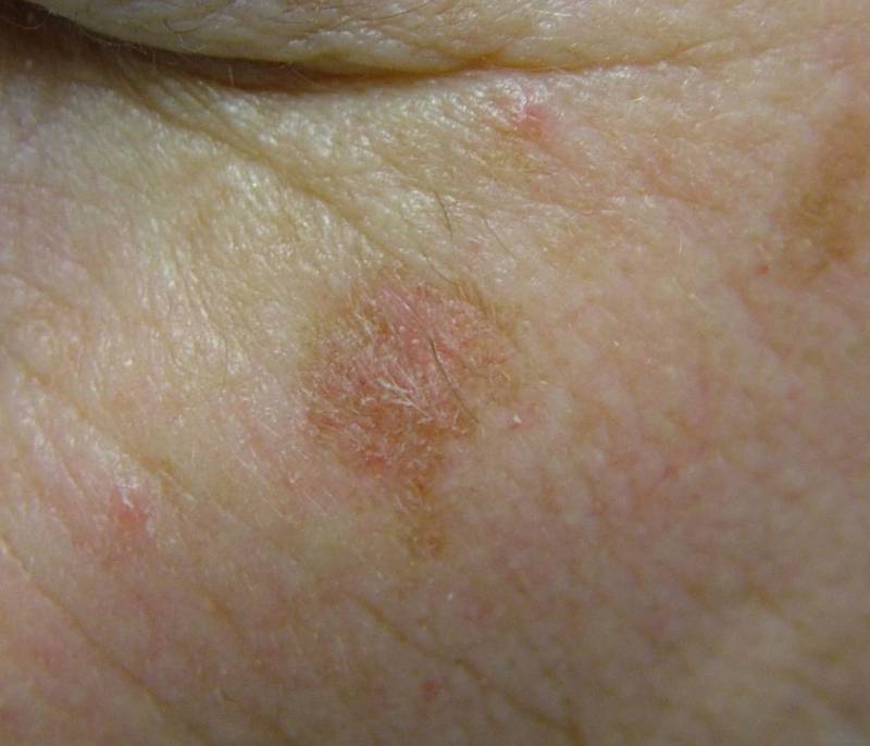 Solar Keratosis – Better Medicine Health Centre & Skin Clinic