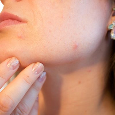 acne-1606765_1920
